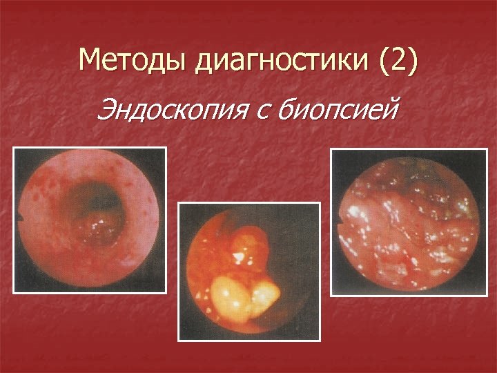 Методы диагностики (2) Эндоскопия с биопсией 