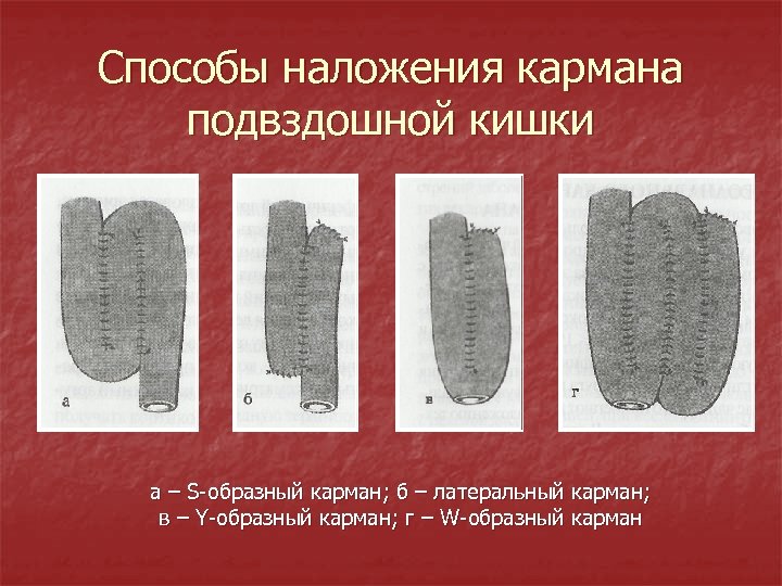 Способы наложения кармана подвздошной кишки а – S-образный карман; б – латеральный карман; в