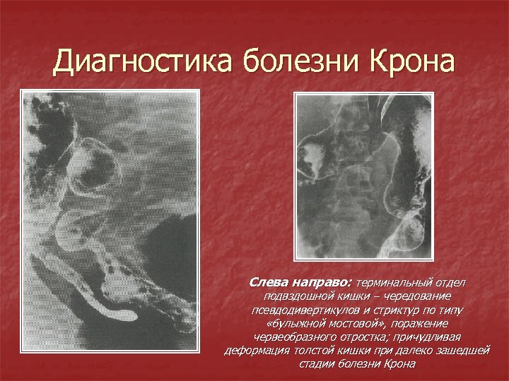 Диагностика болезни Крона Слева направо: терминальный отдел подвздошной кишки – чередование псевдодивертикулов и стриктур
