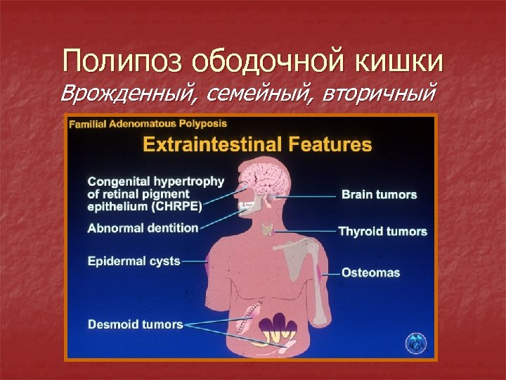 Полипоз ободочной кишки Врожденный, семейный, вторичный 
