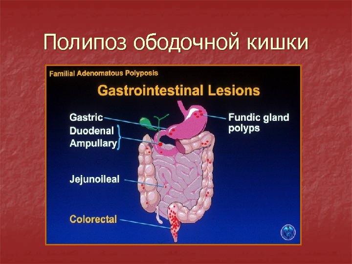 Полипоз ободочной кишки 
