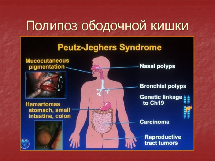 Полипоз ободочной кишки 