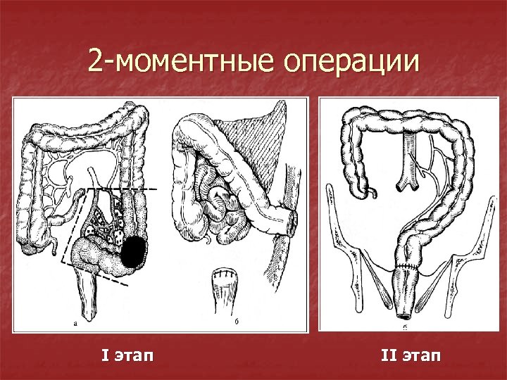 2 -моментные операции I этап II этап 