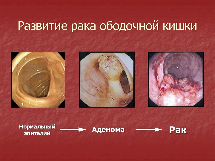 Развитие рака ободочной кишки Нормальный эпителий Аденома Рак 