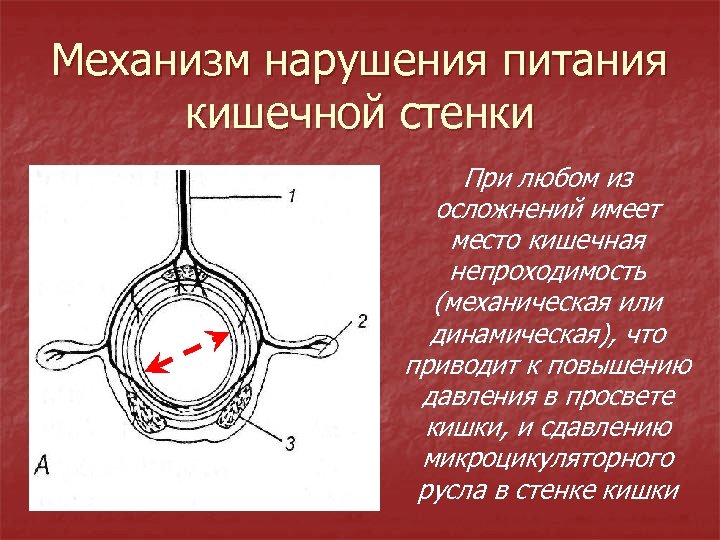 Механизм нарушения питания кишечной стенки При любом из осложнений имеет место кишечная непроходимость (механическая