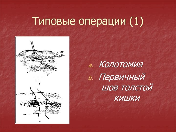 Типовые операции (1) a. b. Колотомия Первичный шов толстой кишки 