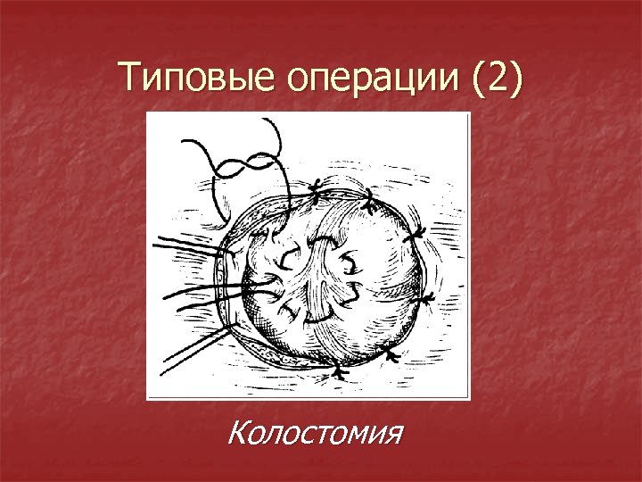 Типовые операции (2) Колостомия 