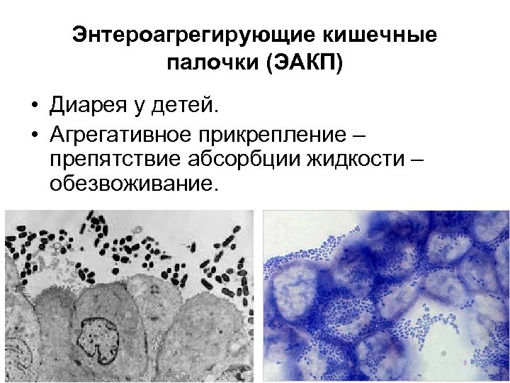 Энтероагрегирующие кишечные палочки (ЭАКП) • Диарея у детей. • Агрегативное прикрепление – препятствие абсорбции