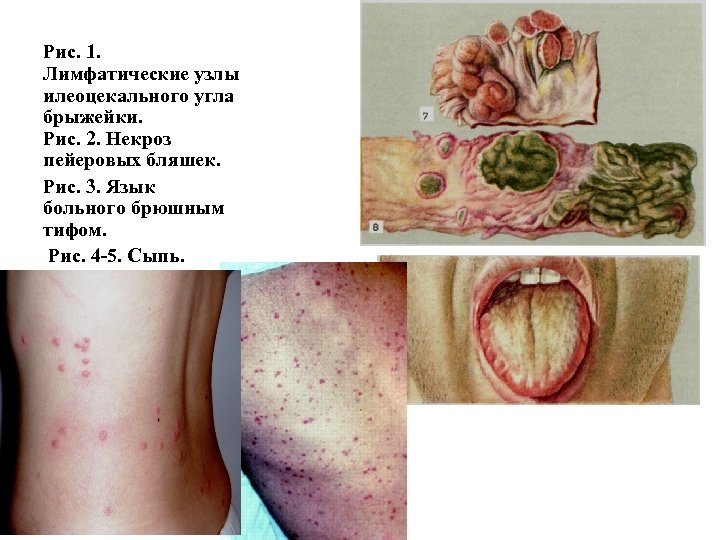 Рис. 1. Лимфатические узлы илеоцекального угла брыжейки. Рис. 2. Некроз пейеровых бляшек. Рис. 3.