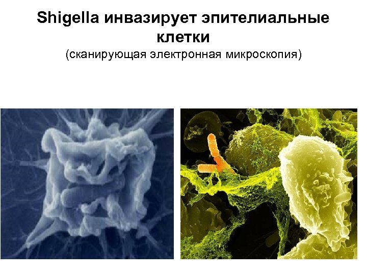 Shigella инвазирует эпителиальные клетки (сканирующая электронная микроскопия) 