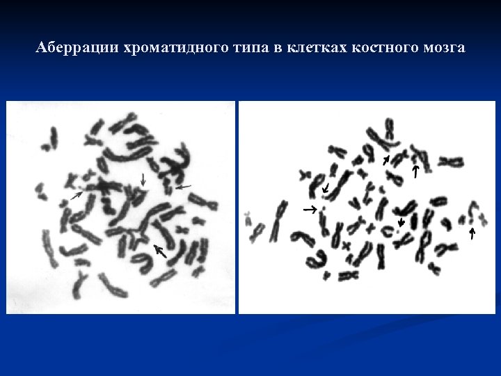 Аберрации хроматидного типа в клетках костного мозга 