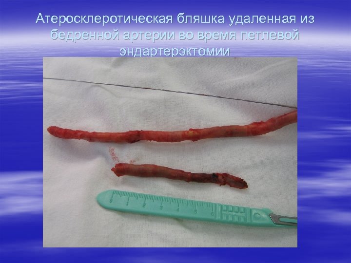 Атеросклеротическая бляшка удаленная из бедренной артерии во время петлевой эндартерэктомии 
