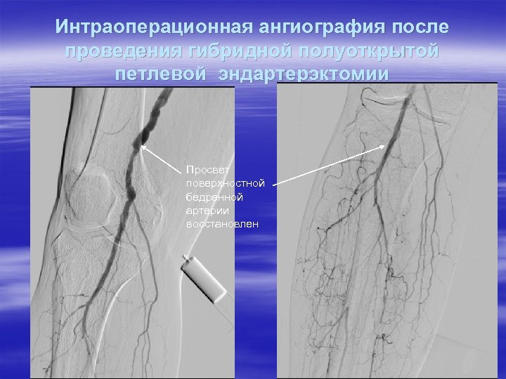 Интраоперационная ангиография после проведения гибридной полуоткрытой петлевой эндартерэктомии Просвет поверхностной бедренной артерии восстановлен 