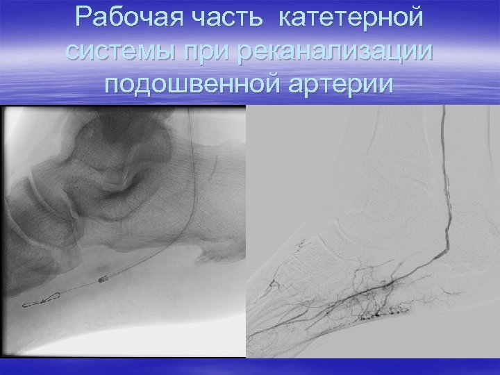 Рабочая часть катетерной системы при реканализации подошвенной артерии 