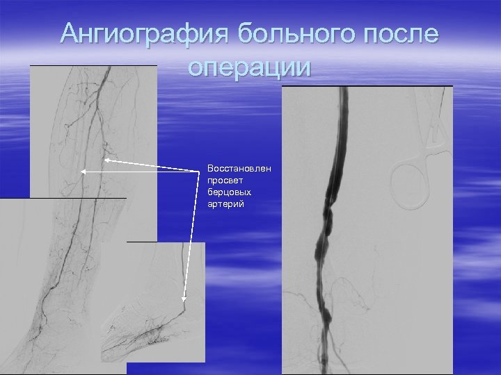 Ангиография больного после операции Восстановлен просвет берцовых артерий 