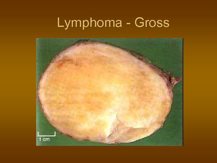 Lymphoma - Gross 