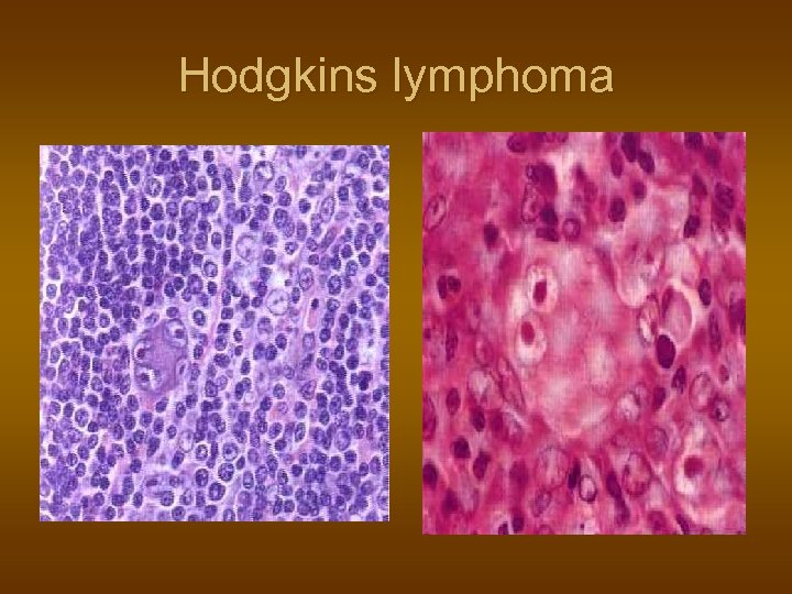 Hodgkins lymphoma 