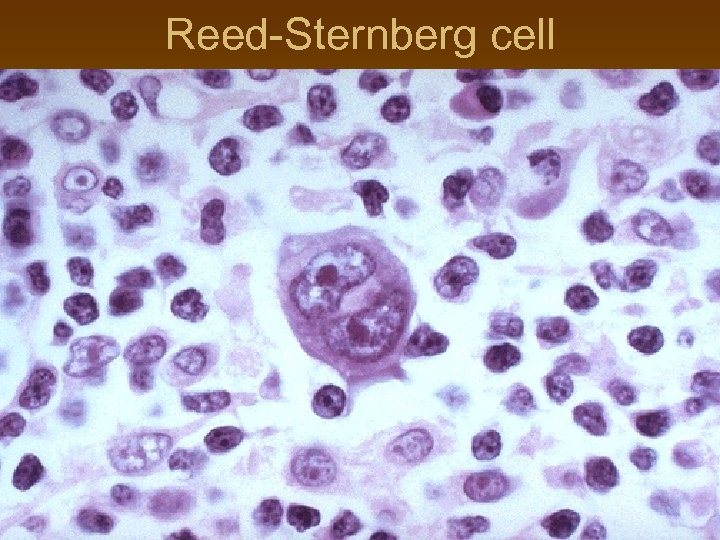 Reed-Sternberg cell 