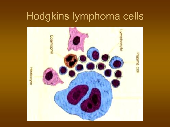 Hodgkins lymphoma cells 