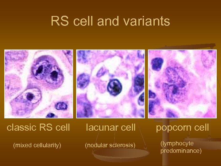 RS cell and variants classic RS cell lacunar cell popcorn cell (mixed cellularity) (nodular