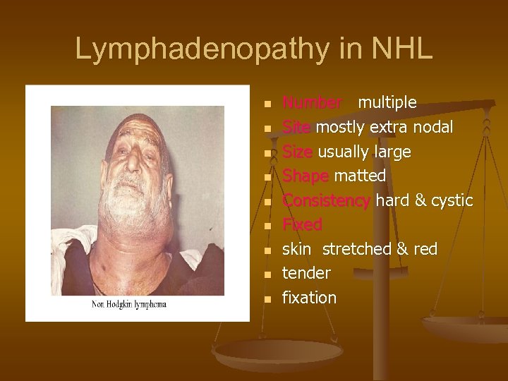 Lymphadenopathy in NHL n n n n n Number multiple Site mostly extra nodal