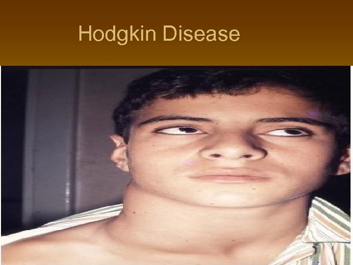 Hodgkin Disease 