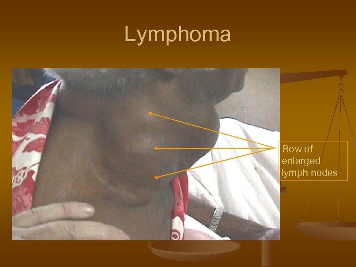 Lymphoma Row of enlarged lymph nodes 