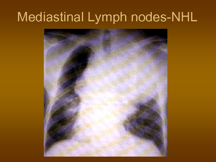 Mediastinal Lymph nodes-NHL 