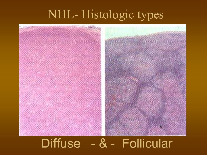 NHL- Histologic types Diffuse - & - Follicular 