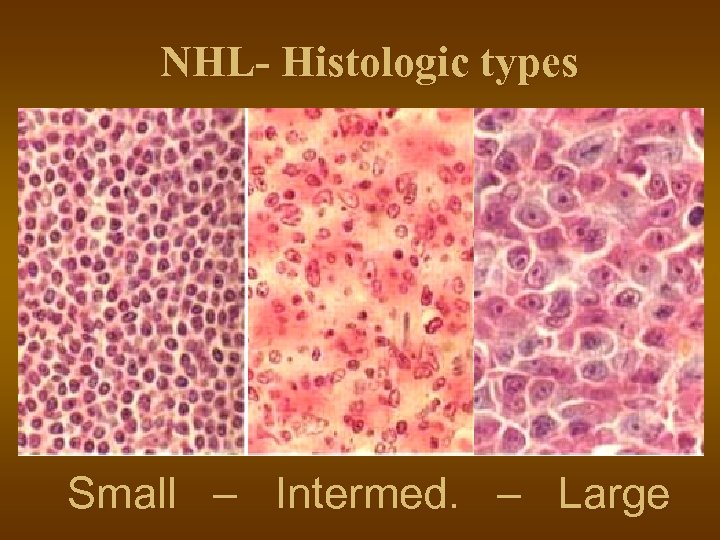 NHL- Histologic types Small – Intermed. – Large 