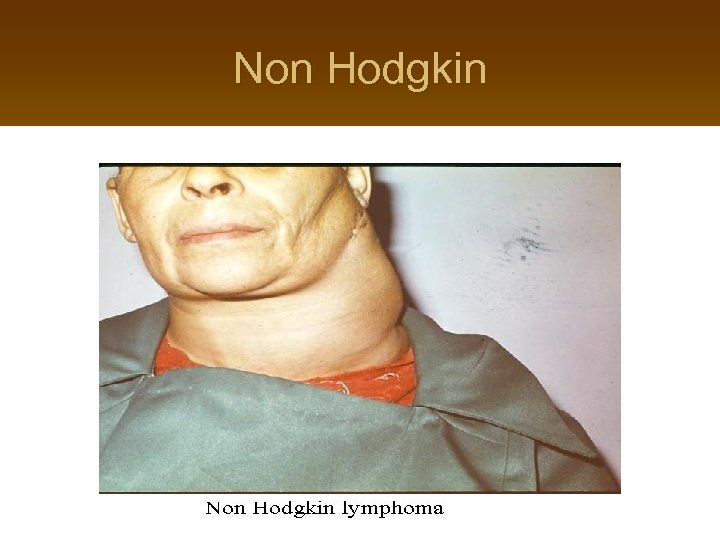 Non Hodgkin 