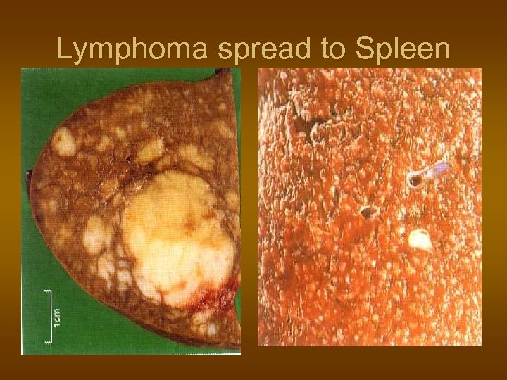 Lymphoma spread to Spleen 