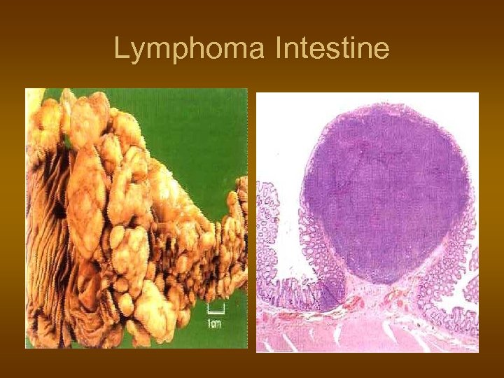 Lymphoma Intestine 