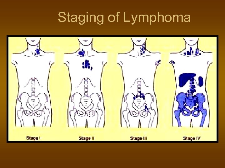 Staging of Lymphoma 