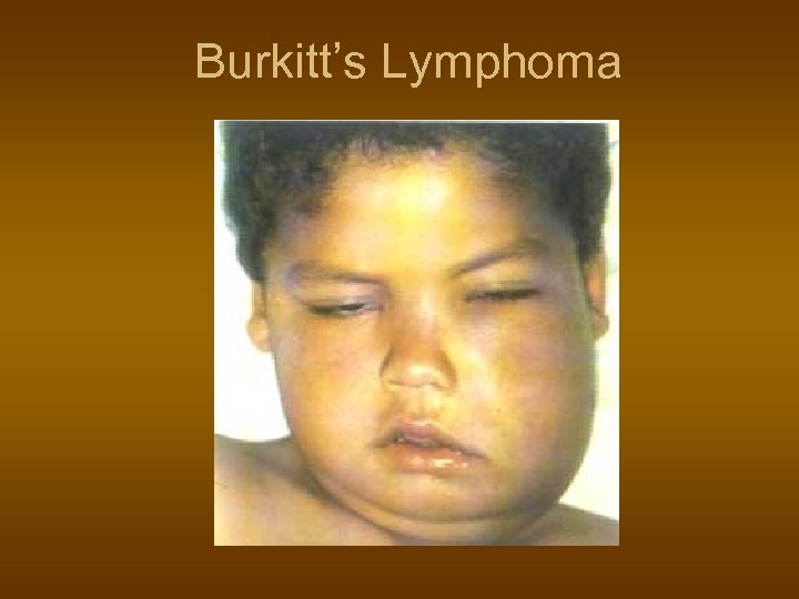 Burkitt’s Lymphoma 