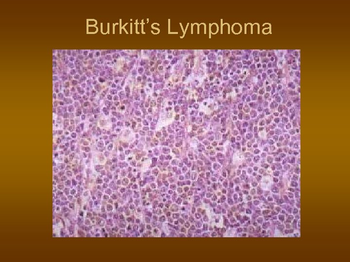 Burkitt’s Lymphoma 