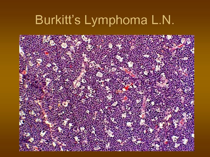 Burkitt’s Lymphoma L. N. 