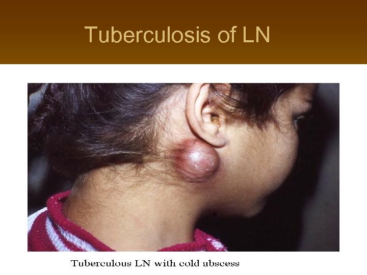 Tuberculosis of LN 