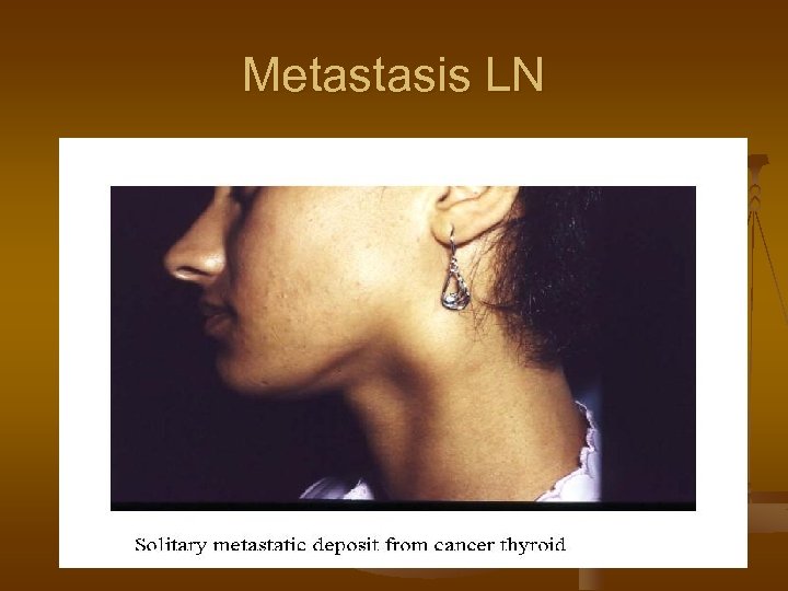 Metastasis LN 