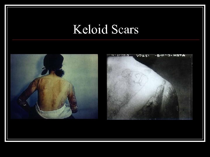 Keloid Scars 