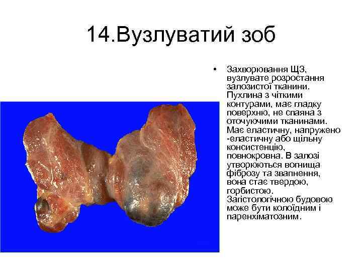 14. Вузлуватий зоб • Захворювання ЩЗ, вузлувате розростання залозистої тканини. Пухлина з чіткими контурами,