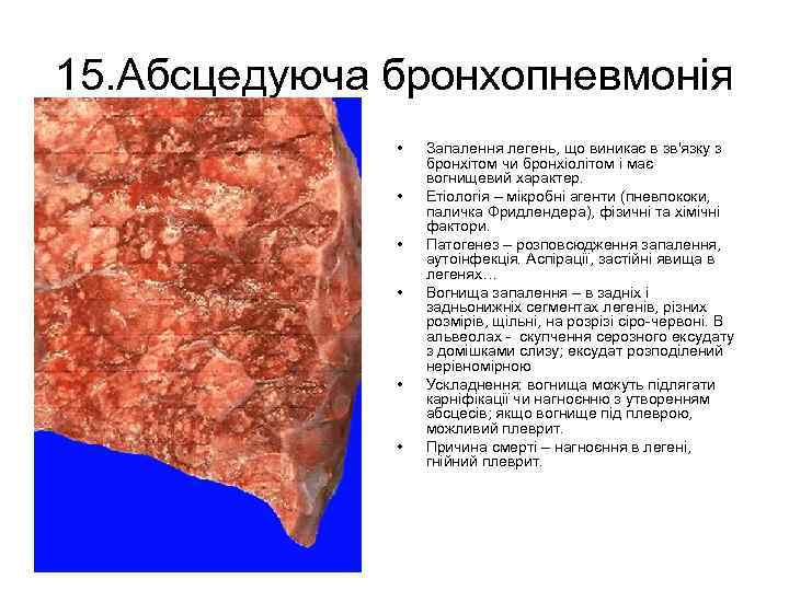 15. Абсцедуюча бронхопневмонія • • • Запалення легень, що виникає в зв'язку з бронхітом