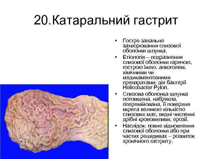 20. Катаральний гастрит • • Гостре запальне захворювання слизової оболонки шлунка. Етіологія – подразнення