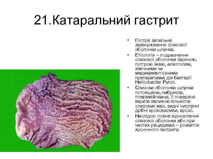 21. Катаральний гастрит • • Гостре запальне захворювання слизової оболонки шлунка. Етіологія – подразнення