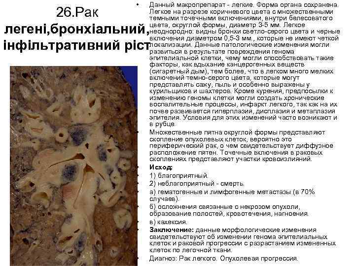  • Данный макропрепарат легкие. Форма органа сохранена. Легкое на разрезе коричневого цвета с