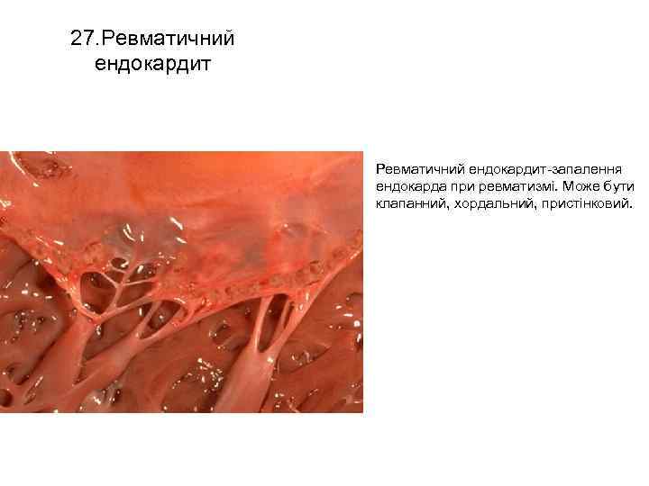 27. Ревматичний ендокардит • Ревматичний ендокардит запалення ендокарда при ревматизмі. Може бути клапанний, хордальний,