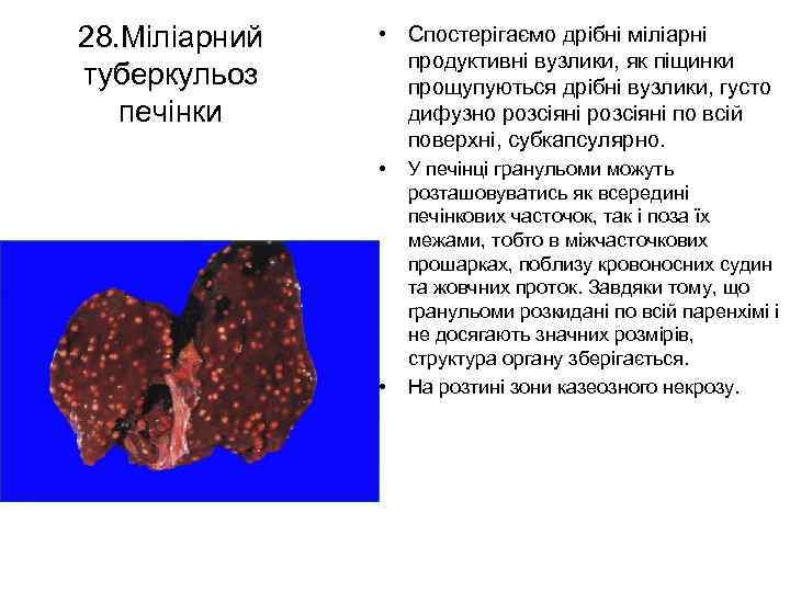 28. Міліарний туберкульоз печінки • Спостерігаємо дрібні міліарні продуктивні вузлики, як піщинки прощупуються дрібні