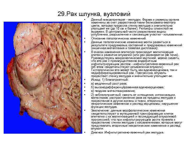 29. Рак шлунка, вузловий • • • Данный макропрепарат желудок. Форма и размеры органа