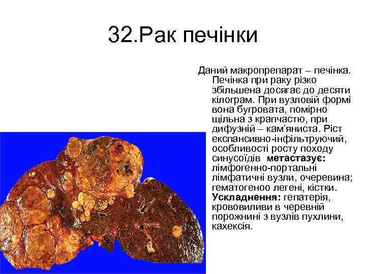 32. Рак печінки Даний макропрепарат – печінка. Печінка при раку різко збільшена досягає до