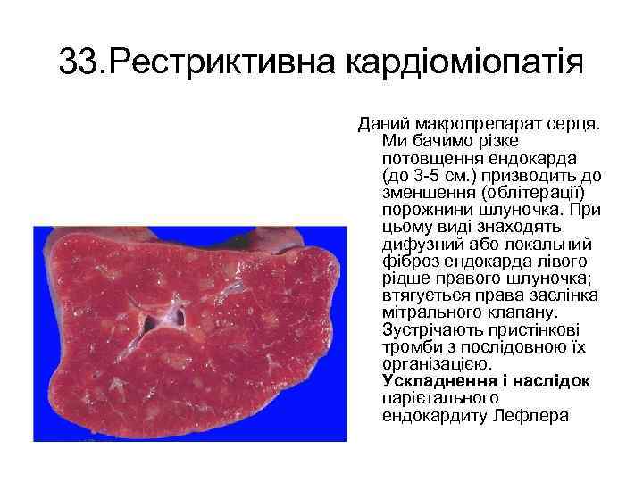 33. Рестриктивна кардіоміопатія Даний макропрепарат серця. Ми бачимо різке потовщення ендокарда (до 3 5